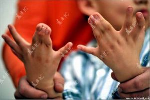 Une terrible difformité.