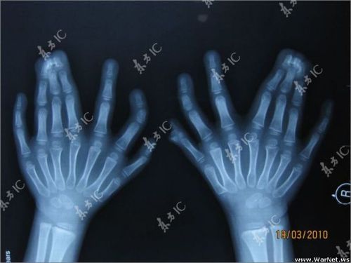 Radiographie des mains.